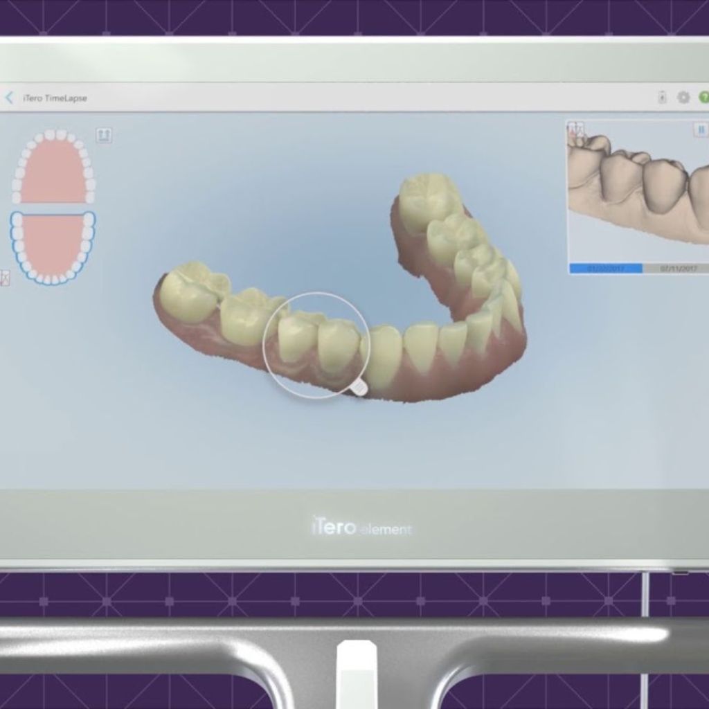 3D Intraoral Scanner Impressions
