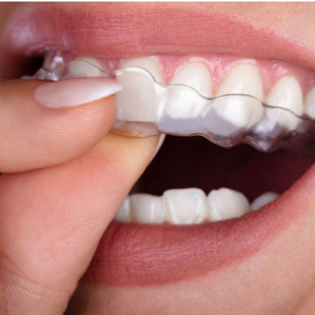 Clear Aligners & Invisible Braces