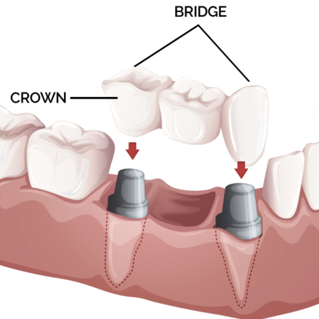 Zirconia Crowns & Ceramic Bridges