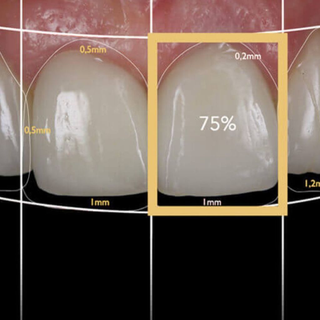 Digital Smile Designing (DSD)