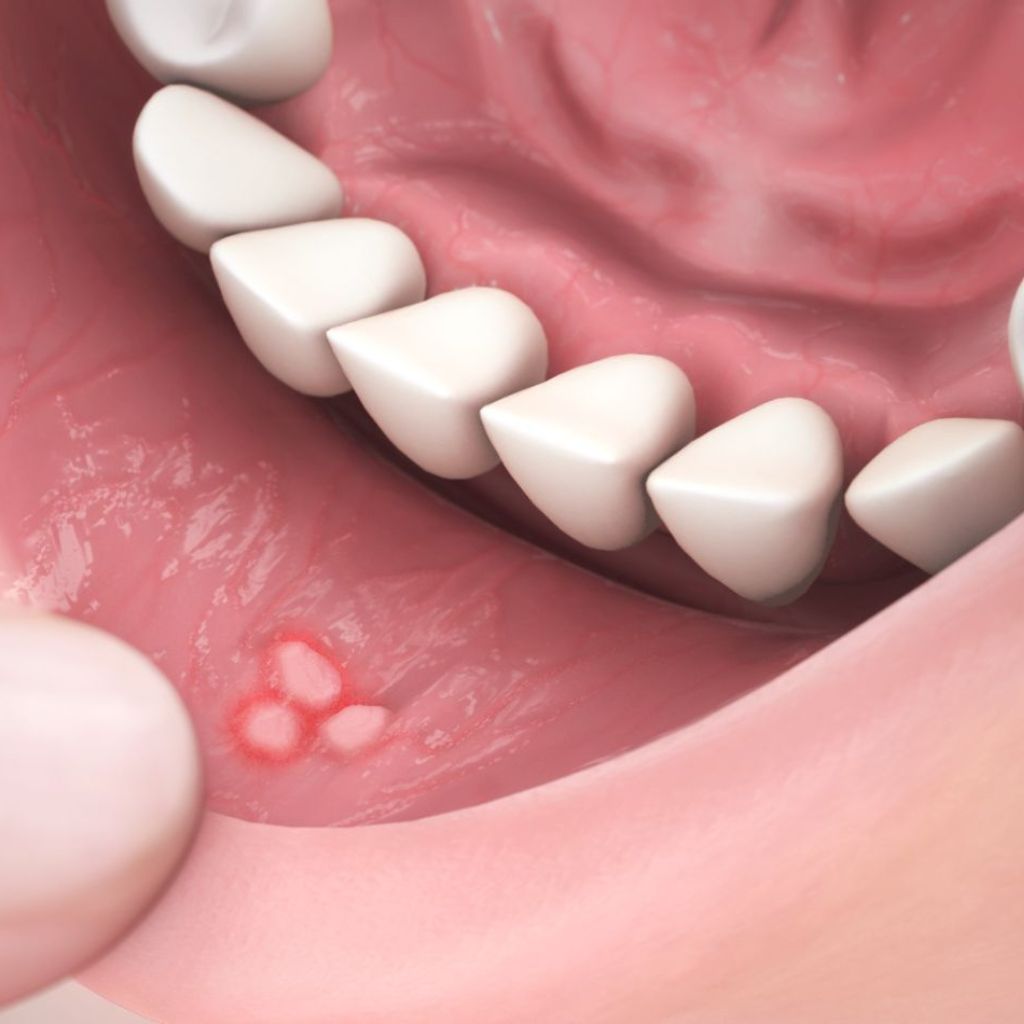 Mouth Ulcers & Lesion Therapy