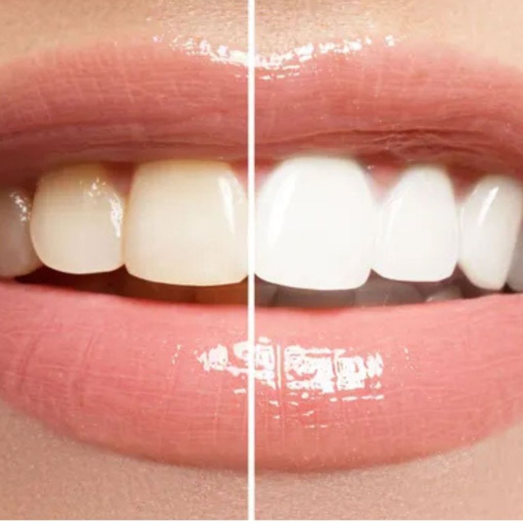 Ceramic & Metal Orthodontic Braces