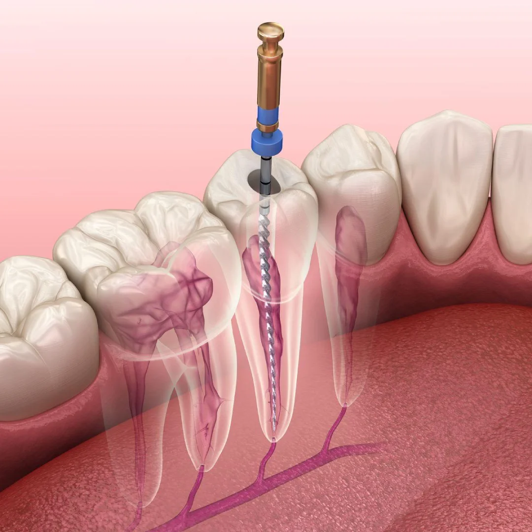 Root Canal Treatment (RCT)