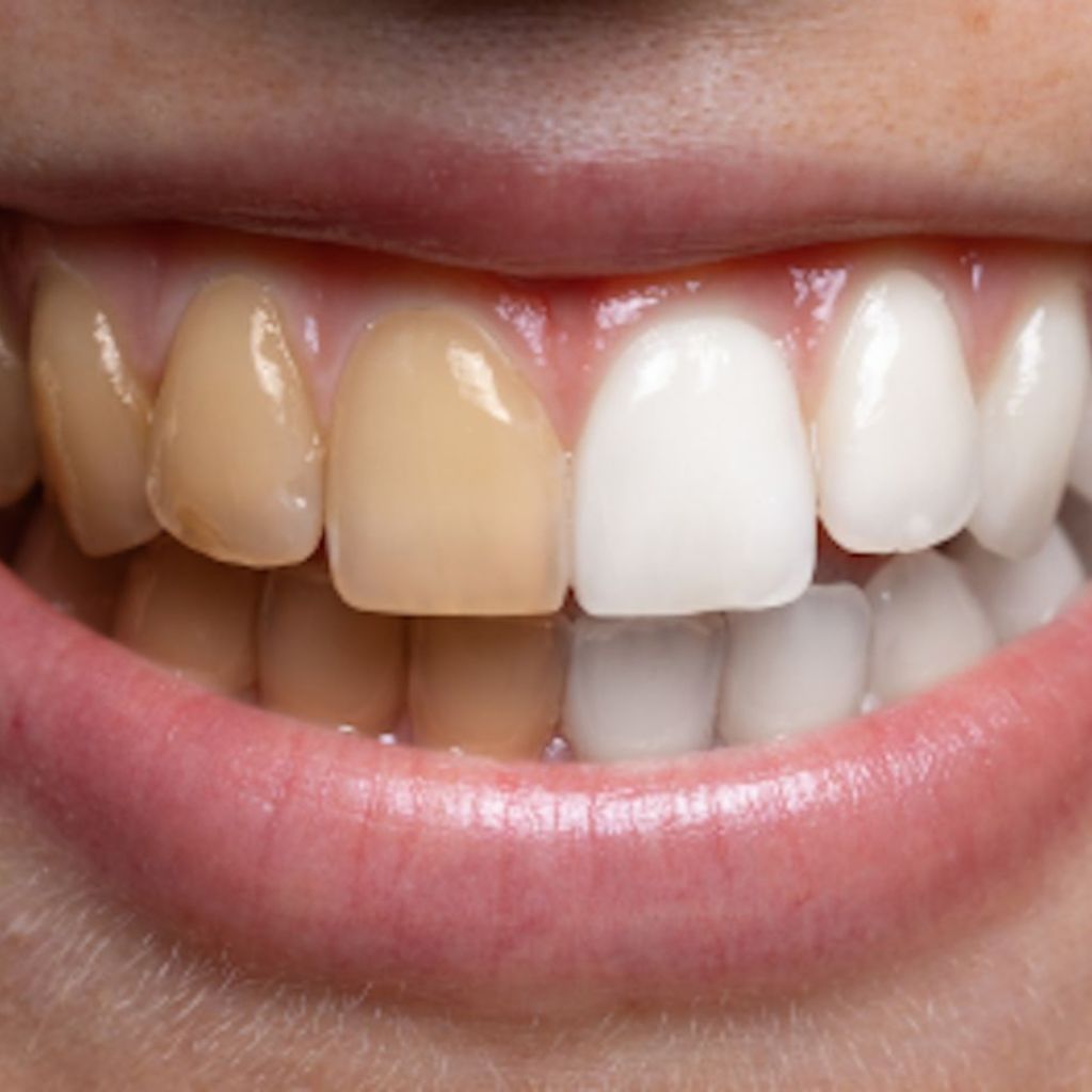 Professional Teeth Whitening