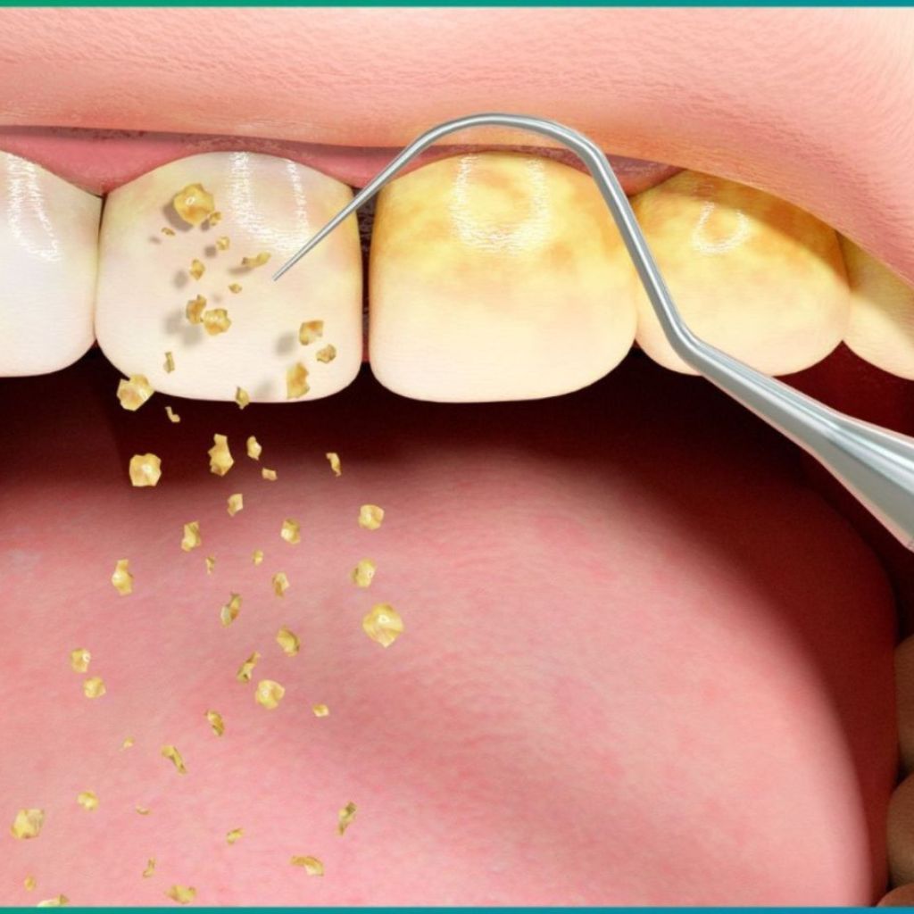 Teeth Cleaning & Air-Flow Polishing