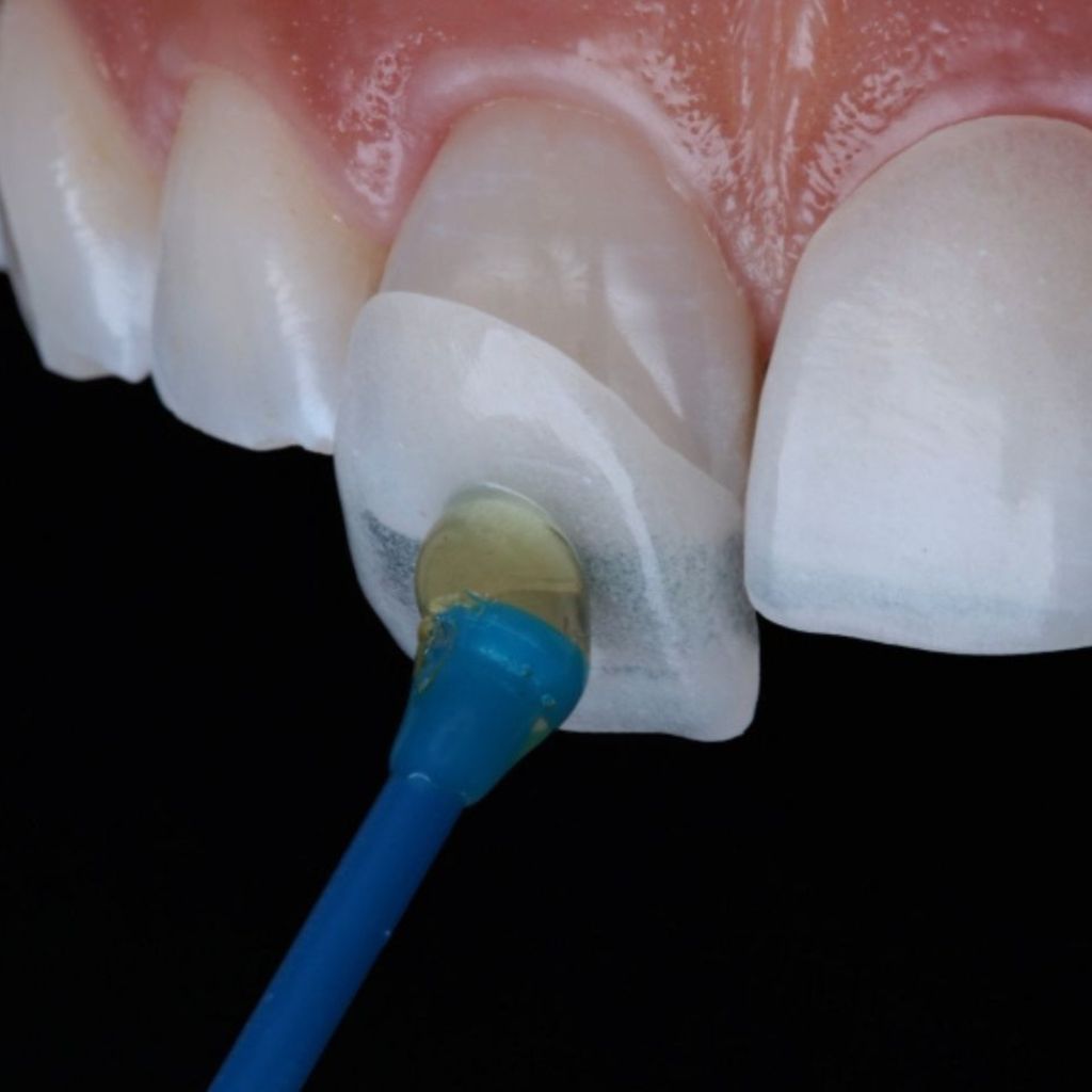 Porcelain Veneers & Dental Laminates